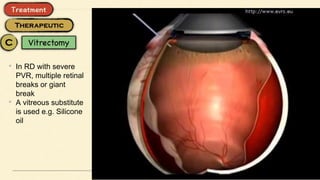 • In RD with severe
PVR, multiple retinal
breaks or giant
break
• A vitreous substitute
is used e.g. Silicone
oil
 