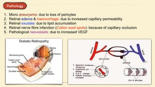 1. Micro aneurysms: due to loss of pericytes
2. Retinal edema & haemorrhage: due to increased capillary permeability
3. Retinal exudate: due to lipid accumulation
4. Retinal nerve fibre infarction (Cotton wool spots): because of capillary occlusion
5. Pathological neovessels: due to increased VEGF
 