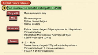 • Micro aneurysms only
• Micro aneurysms
• Retinal haemorrhages
• Retinal Exudate
• Retinal haemorrhage > 20 per quadrant in 1-3 quadrants
• Venous beading
• Intra Retinal Microvascular Anomalies (IRMA)
• Cotton Wool Spots (CWS)
4 - 2 - 1 Rule
• Severe haemorrhage (>20/quadrant) in 4 quadrants
• Venous beading in 2 or more quadrants
• IRMA in 1 or more quadrants
 