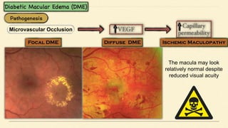 Microvascular Occlusion
The macula may look
relatively normal despite
reduced visual acuity
 