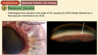 • Pathological new vessels in the angle of AC causing 2ry OAG initially followed by a
fibrovascular membrane & 2ry ACG
 