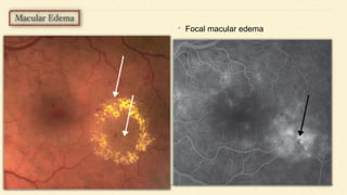 • Focal macular edema
 