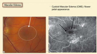 • Cystoid Macular Edema (CME): flower
petal appearance
 