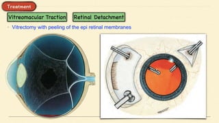 • Vitrectomy with peeling of the epi retinal membranes
 