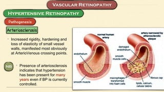 • Increased rigidity, hardening and
loss of elasticity of small vessel
walls, manifested most obviously
at ArterioVenous crossing points.
• Presence of arteriosclerosis
indicates that hypertension
has been present for many
years even if BP is currently
controlled.
 