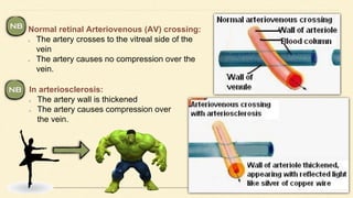 Normal retinal Arteriovenous (AV) crossing:
The artery crosses to the vitreal side of the
vein
The artery causes no compression over the
vein.
In arteriosclerosis:
The artery wall is thickened
The artery causes compression over
the vein.
 