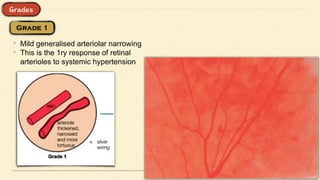 • Mild generalised arteriolar narrowing
• This is the 1ry response of retinal
arterioles to systemic hypertension
 