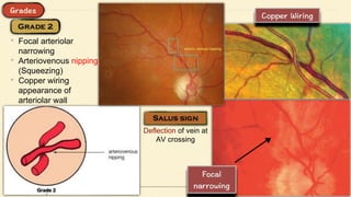 • Focal arteriolar
narrowing
• Arteriovenous nipping
(Squeezing)
• Copper wiring
appearance of
arteriolar wall
Deflection of vein at
AV crossing
 