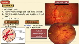 • As Grade 2 Plus:
A. Retinal haemorrhage (dot, blot, flame shaped)
B. Retinal exudate (Macular star; exudate in foveal
area)
C. Cotton wool spots
Banking of vein distal
to AV crossing
Tapering of vein on either
side of AV crossing
 