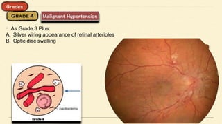 • As Grade 3 Plus:
A. Silver wiring appearance of retinal arterioles
B. Optic disc swelling
 