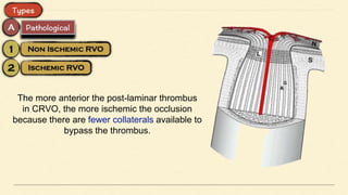 The more anterior the post-laminar thrombus
in CRVO, the more ischemic the occlusion
because there are fewer collaterals available to
bypass the thrombus.
 