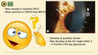• New vessels in ischemic RVO
• More common in CRVO than BRVO
• Develop at pupillary border
• May develop at the AC angle within 2
- 4 months (100 day glaucoma)
 