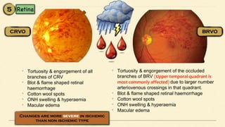 • Tortuosity & engorgement of all
branches of CRV
• Blot & flame shaped retinal
haemorrhage
• Cotton wool spots
• ONH swelling & hyperaemia
• Macular edema
• Tortuosity & engorgement of the occluded
branches of BRV (Upper temporal quadrant is
most commonly affected) due to larger number
arteriovenous crossings in that quadrant.
• Blot & flame shaped retinal haemorrhage
• Cotton wool spots
• ONH swelling & hyperaemia
• Macular edema
 