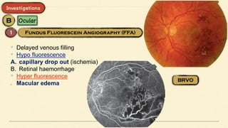 • Delayed venous filling
• Hypo fluorescence
A. capillary drop out (ischemia)
B. Retinal haemorrhage
• Hyper fluorescence
Macular edema
 