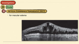 • for macular edema
 