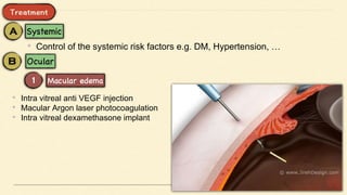 • Control of the systemic risk factors e.g. DM, Hypertension, …
• Intra vitreal anti VEGF injection
• Macular Argon laser photocoagulation
• Intra vitreal dexamethasone implant
 