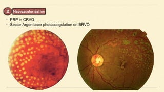 • PRP in CRVO
• Sector Argon laser photocoagulation on BRVO
 