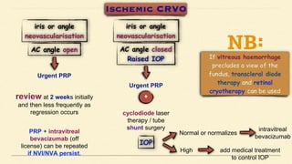 Urgent PRP
review at 2 weeks initially
and then less frequently as
regression occurs
PRP + intravitreal
bevacizumab (off
license) can be repeated
if NVI/NVA persist.
Urgent PRP
cyclodiode laser
therapy / tube
shunt surgery
Normal or normalizes
intravitreal
bevacizumab
High add medical treatment
to control IOP
 