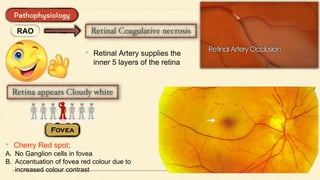 RAO
• Retinal Artery supplies the
inner 5 layers of the retina
• Cherry Red spot;
A. No Ganglion cells in fovea
B. Accentuation of fovea red colour due to
increased colour contrast
 