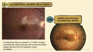 A cilioretinal artery is present in 15–50% of eyes,
providing the central macula with a second arterial
supply derived from the posterior ciliary
circulation.
 