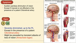 • Sudden painless diminution of vision
• Except if macula is not affected or the
presence of a patent Cilioretinal artery
• Severely diminished, up to No PL
• Except in the presence of a patent
Cilioretinal artery
• Might be preceded by transient attacks of
loss of vision (Amaurosis fugax)
 