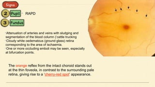 • RAPD
•Attenuation of arteries and veins with sludging and
segmentation of the blood column (‘cattle trucking
•Cloudy white oedematous (ground glass) retina
corresponding to the area of ischaemia.
•One or more occluding emboli may be seen, especially
at bifurcation points.
The orange reflex from the intact choroid stands out
at the thin foveola, in contrast to the surrounding pale
retina, giving rise to a ‘cherry-red spot’ appearance.
 