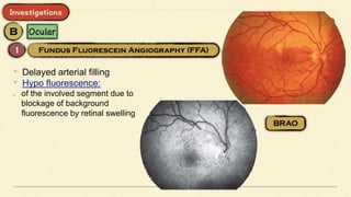 • Delayed arterial filling
• Hypo fluorescence:
of the involved segment due to
blockage of background
fluorescence by retinal swelling
 