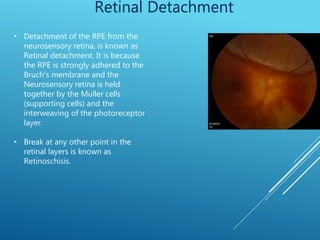Retina | PPTX