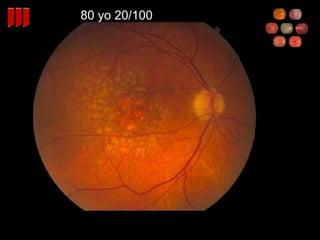 Retina Review - Part 1 | PPT