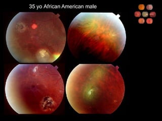 35 yo African American male 