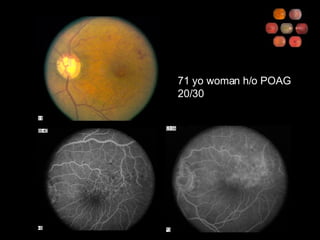 71 yo woman h/o POAG 20/30 