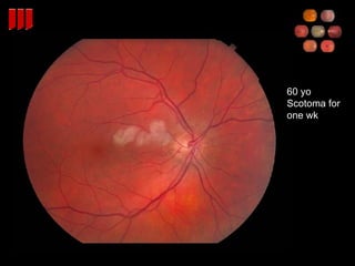 60 yo  Scotoma for  one wk 