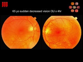 65 yo sudden decreased vision OU x 4hr 