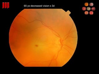 65 yo decreased vision x 3d 