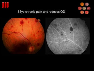 85yo chronic pain and redness OD 