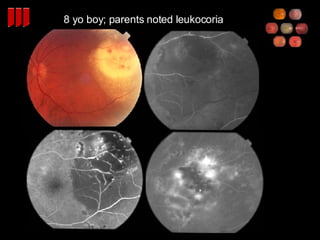 8 yo boy; parents noted leukocoria 
