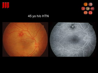 45 yo h/o HTN 