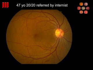 47 yo 20/20 referred by internist 