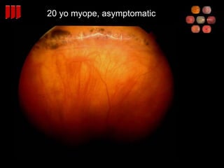 20 yo myope, asymptomatic 