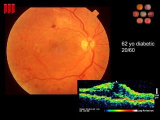 62 yo diabetic 20/60 