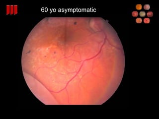 60 yo asymptomatic 