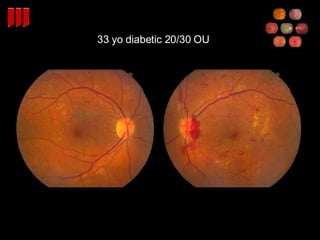 33 yo diabetic 20/30 OU 