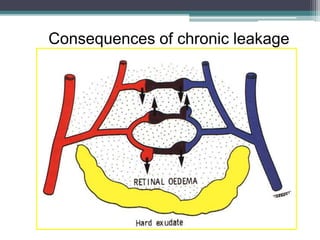 Consequences of chronic leakage
 