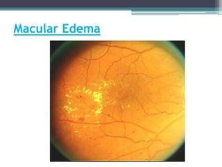 Macular Edema
 
