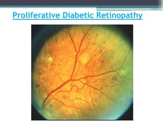 Proliferative Diabetic Retinopathy
 