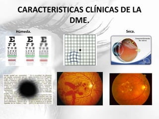 CARACTERISTICAS CLÍNICAS DE LA
DME.
Húmeda. Seca.
 
