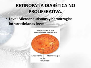 RETINOPATÍA DIABÉTICA NO
PROLIFERATIVA.
• Leve: Microaneurismas y hemorragias
intrarretinianas leves.
 