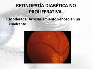 RETINOPATÍA DIABÉTICA NO
PROLIFERATIVA.
• Moderada: Arrosariamiento venoso en un
cuadrante.
 