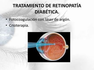 TRATAMIENTO DE RETINOPATÍA
DIABÉTICA.
• Fotocoagulación con láser de argón.
• Crioterapia.
 