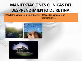 MANIFESTACIONES CLÍNICAS DEL
DESPRENDIMIENTO DE RETINA.
60% de los pacientes, premonitorios. 40% de los pacientes, no
premonitorios.
 